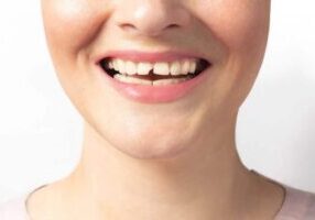 Chipped Tooth