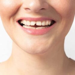 Chipped Tooth